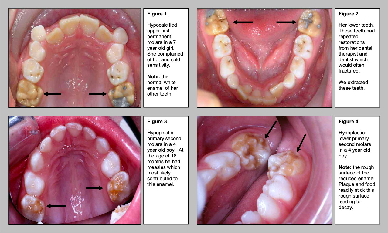 Dental laser